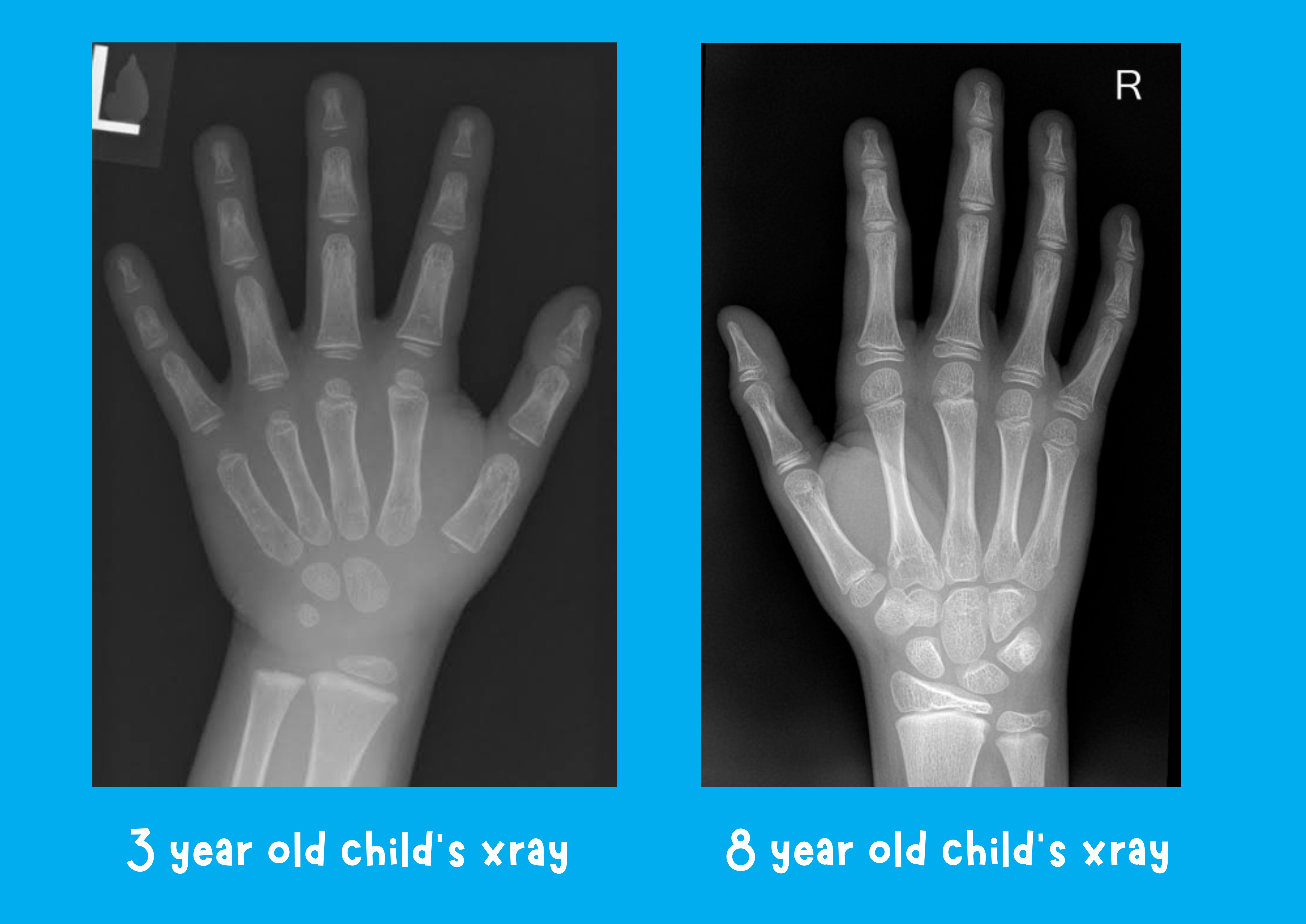 3 Year Old Child’S Xray